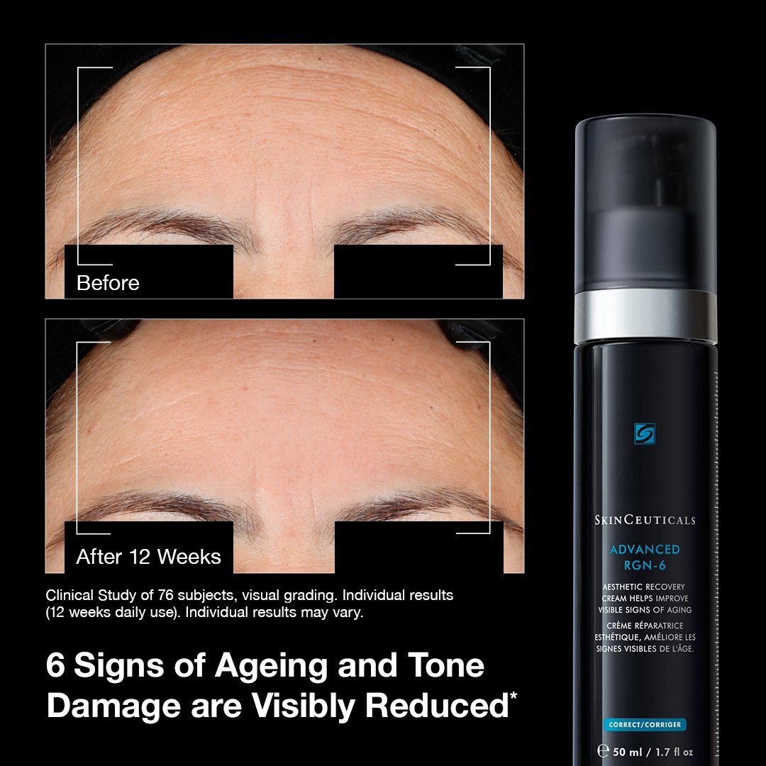 Before and after comparison of skin aging and tone damage with skinceuticals advanced rgn 6 cream