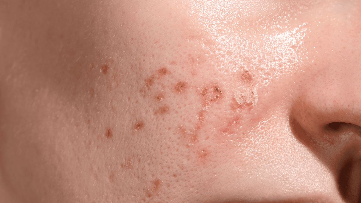 How to fade the look of post-blemish marks