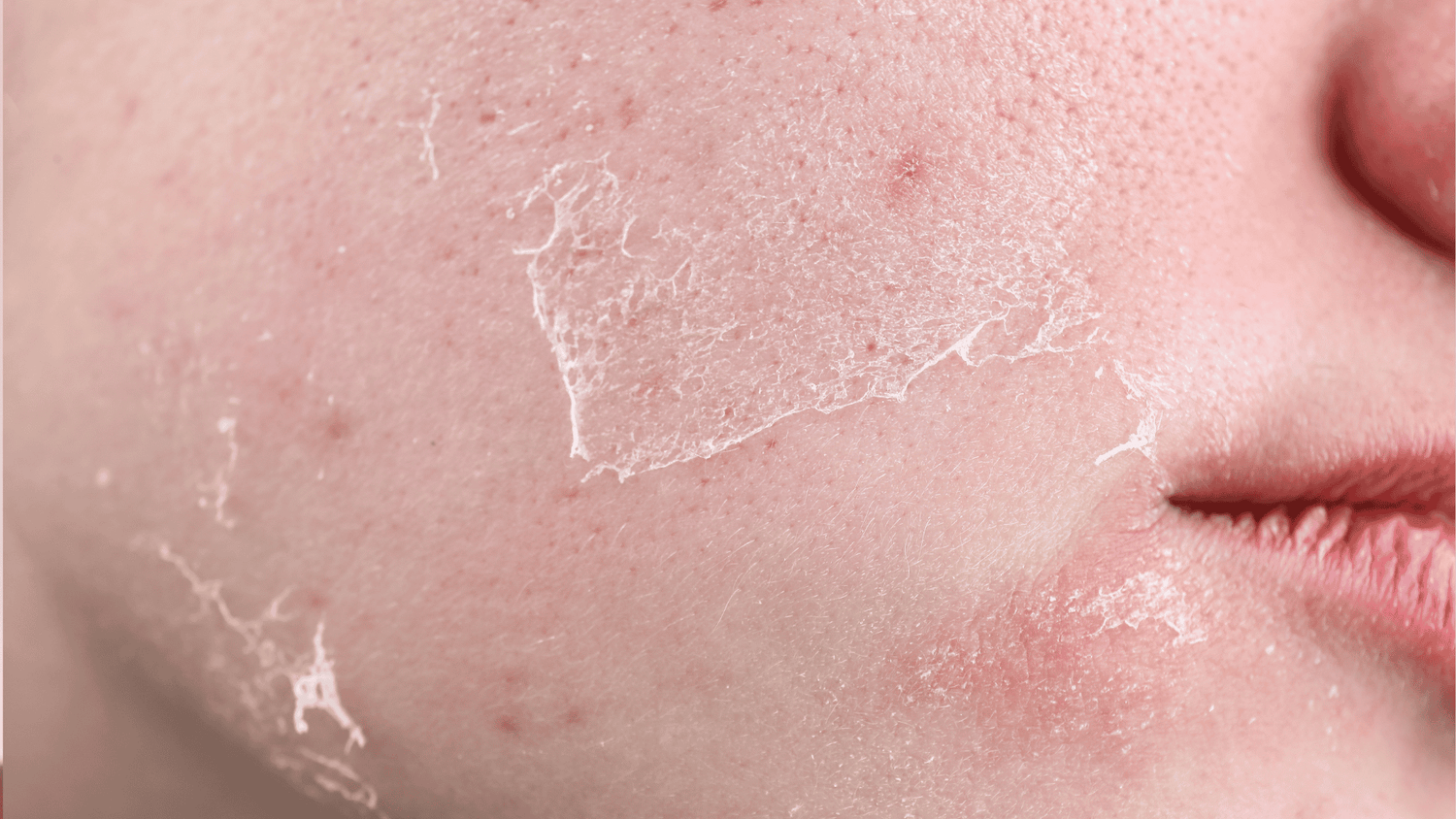Skin barrier 101: how to know if yours is damaged