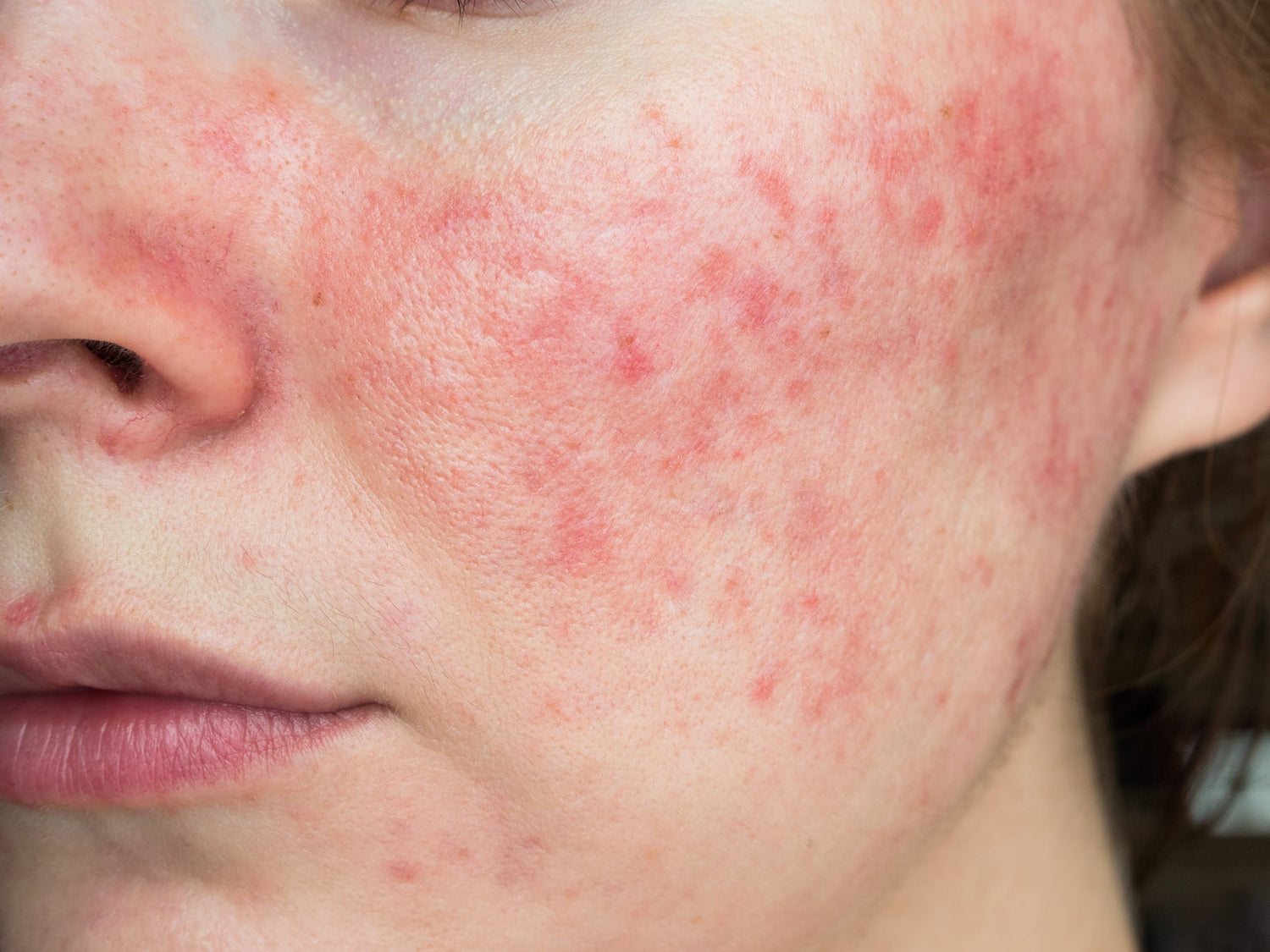 Redness &amp; Rosacea