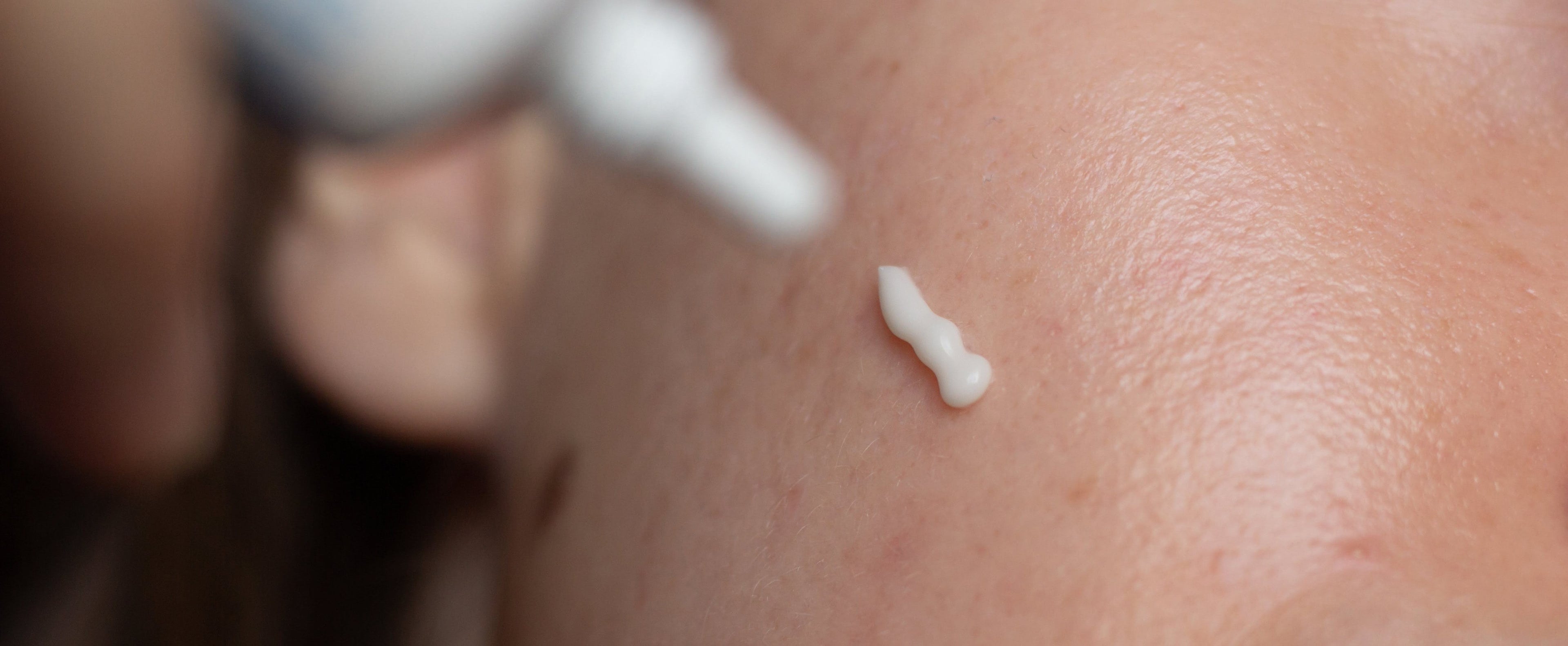Hyperpigmentation & Dark Spots
