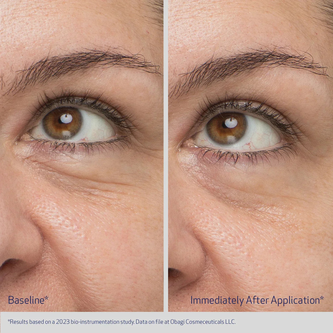 Before and after comparison of eye area with visible skin texture improvement.