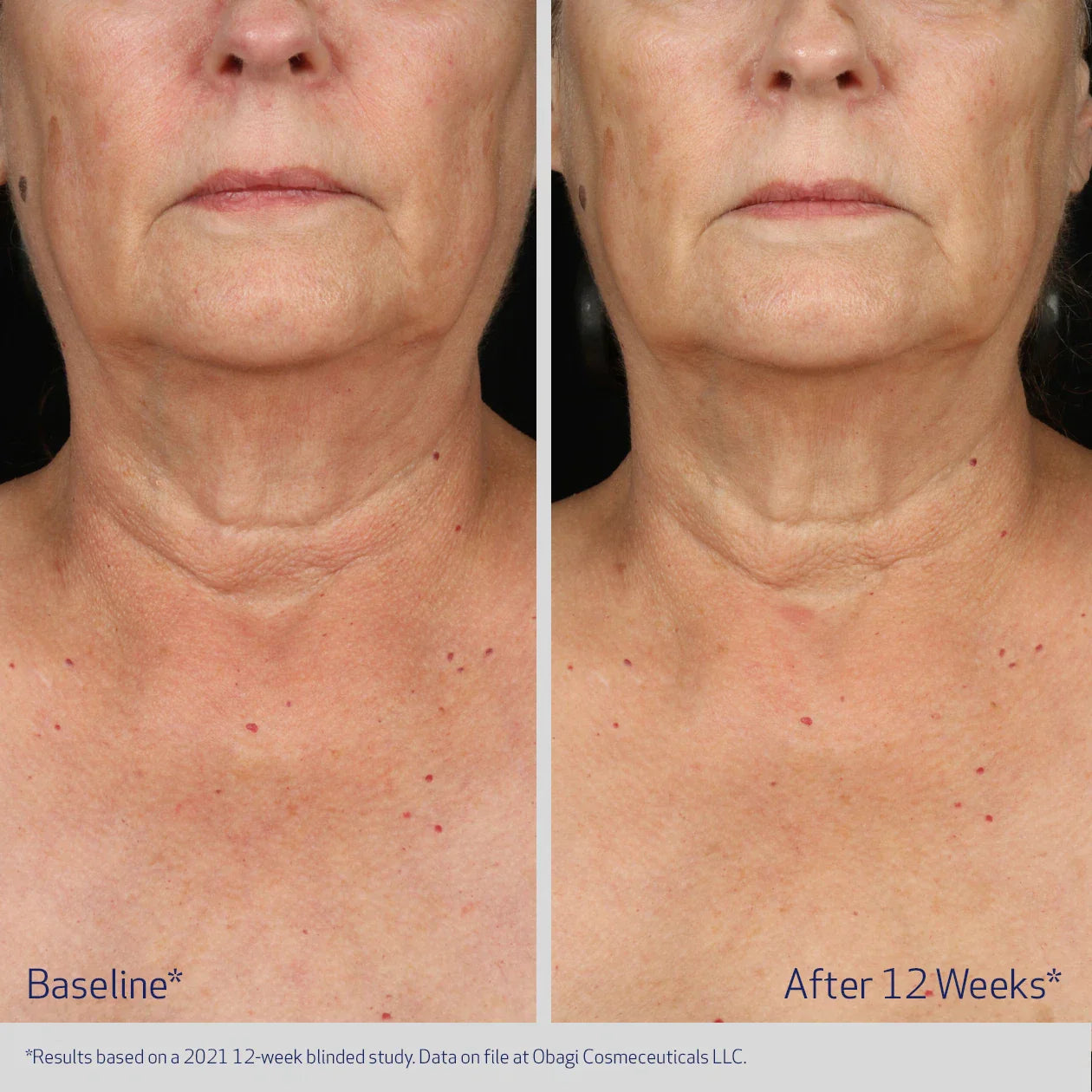 Before and after comparison of a woman&